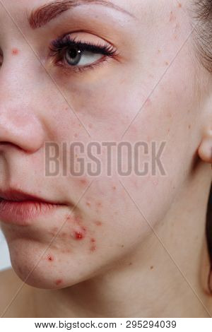 Young Women With Problematic Skin And Pimples On Her Face. Feamle Showing Her Acne. Skincare, Beauty