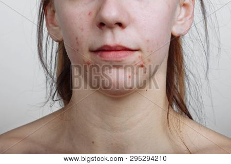 Young Women With Problematic Skin And Pimples On Her Face. Feamle Showing Her Acne. Skincare, Beauty