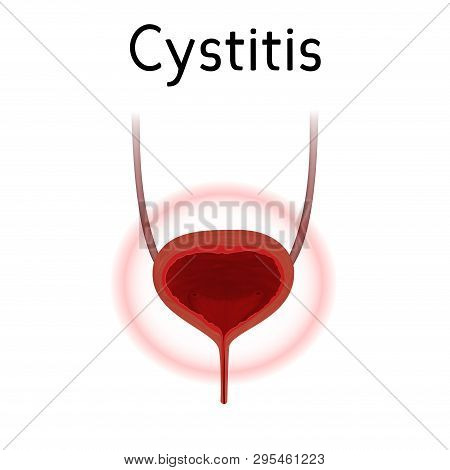 Anatomy Picture Of Bladder Infection, Pain. Cistitis. Realistic Medical Illustration.