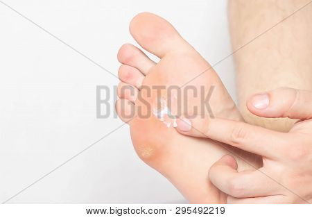 The Person Rubs The Medical Ointment In The Soles Of The Problem And Dry Skin With Mazols And Corns 
