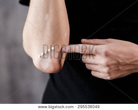 Vitiligo Close-up On Hands And Elbows. Man Smears Pigment Cream. Cares For The Skin. Vitiligi Treatm