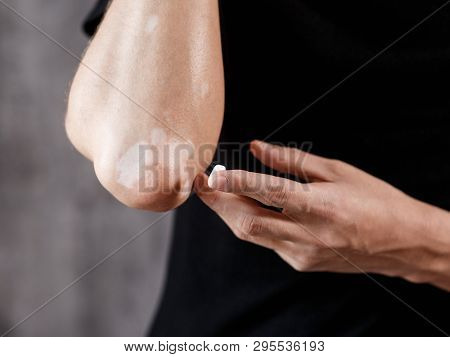 Vitiligo Close-up On Hands And Elbows. Man Smears Pigment Cream. Cares For The Skin. Vitiligi Treatm