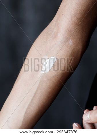 Vitiligo Close-up On Hands And Elbows. Man Smears Pigment Cream. Cares For The Skin. Vitiligi Treatm