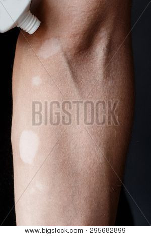 Vitiligo Close-up On Hands And Elbows. Man Smears Pigment Cream. Cares For The Skin. Vitiligi Treatm