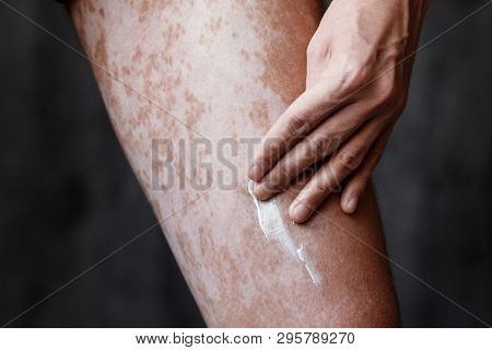 Vitiligo Close-up On The Legs Of A Man. A Young Guy Cares For The Skin, Smears The Skin With Pigment
