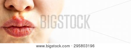 Part Of A Young Woman Face With Red Bubbles Of Virus Herpes On Lips Medicine, Treatment. Long Horizo