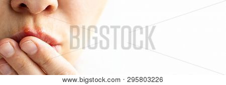 Part Of A Young Woman Face With Red Bubbles Of Virus Herpes On Lips That She Tries To Hide With Her 