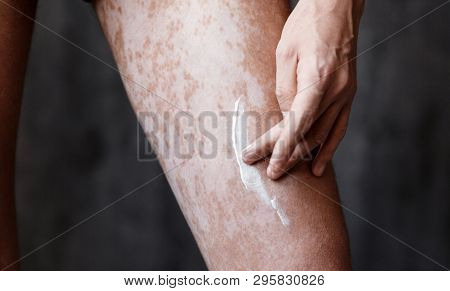 Vitiligo Close-up On The Legs Of A Man. A Young Guy Cares For The Skin, Smears The Skin With Pigment