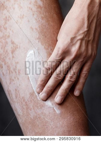 Vitiligo Close-up On The Legs Of A Man. A Young Guy Cares For The Skin, Smears The Skin With Pigment
