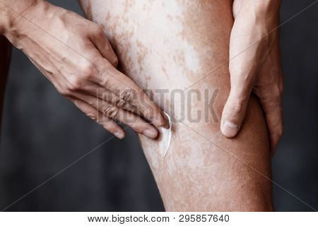 Vitiligo Close-up On The Legs Of A Man. A Young Guy Cares For The Skin, Smears The Skin With Pigment