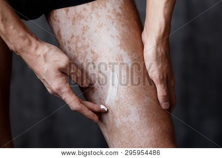 Vitiligo Close-up On The Legs Of A Man. A Young Guy Cares For The Skin, Smears The Skin With Pigment