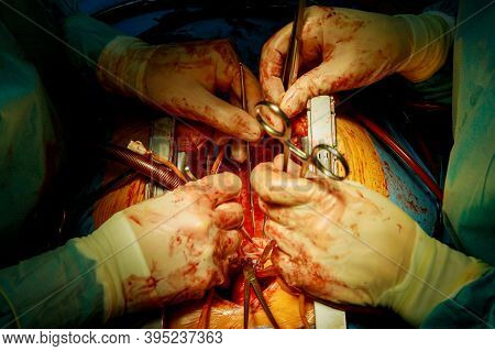 Patient During A Heart Surgery At A Hospital In The Surgical Operating Room
