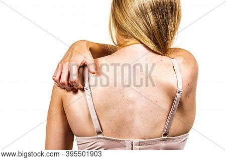 Woman With Skin Problem Acne On Back