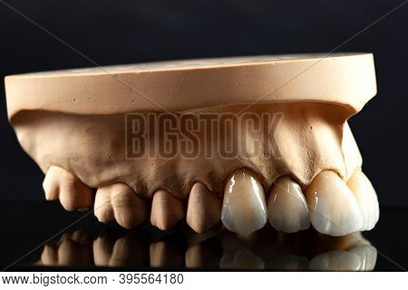 Close-up View Of Dental Layout Of Upper Veneers Of Teeth Prothesis
