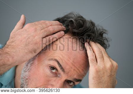 Man Checking His Hair Loss And Dandruff