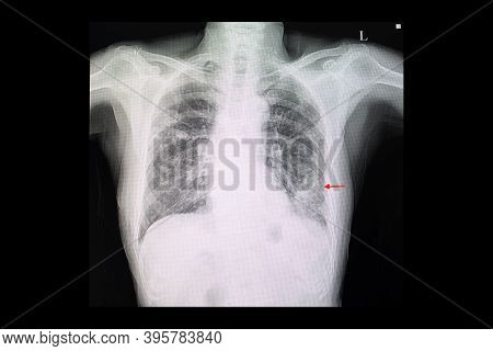 A Chest X-ray Film Of A Patient With Left Lower Lung Pneumonia And Right Upper Lung Nodules