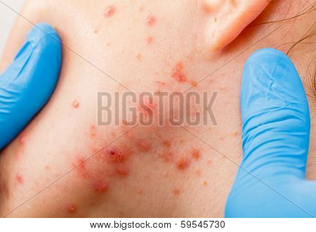 Acne Skin