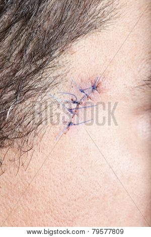 Stitches On Man Face