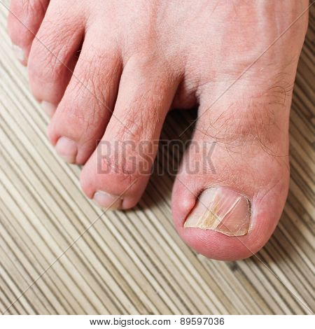 Damaged toenail