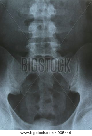 Radiografía de la pelvis