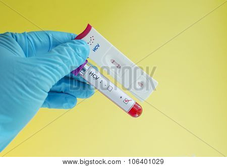 Hepatitis C virus (HCV) testing positive