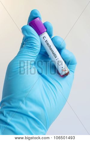 Chlamydia trachomatis blood sample