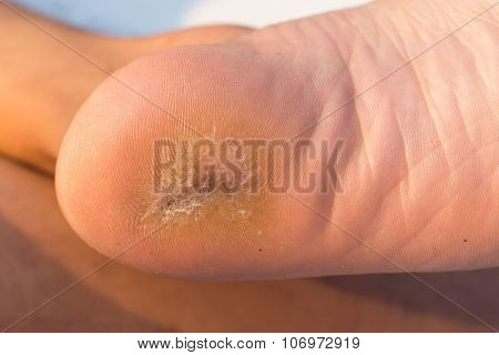 foot corn