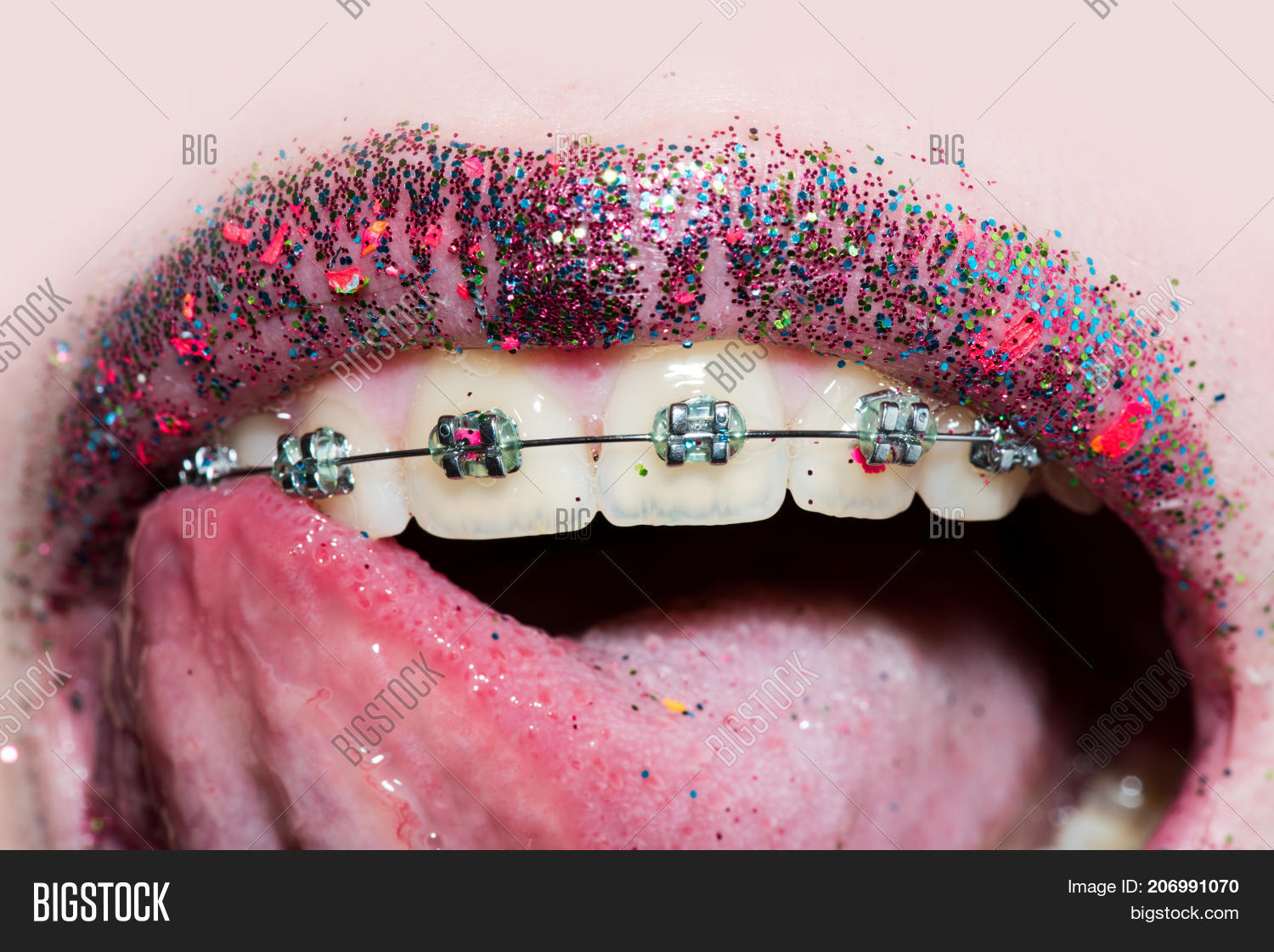 braces sexy girl Dental Braces On Image & Photo (Free Trial) | Bigstock