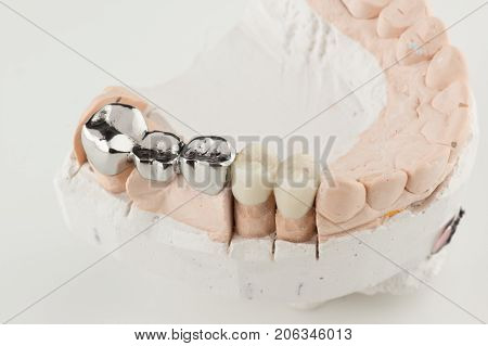 Bridged dental prostheses are made of steel and ceramic paste