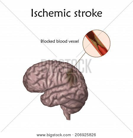 Ischemic Stoke poster, banner. Vector medical illustration. white background, anatomy image of damaged human brain, blocked blood vessel.