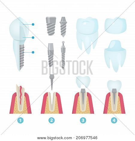 Set of dental crowns and implantation prosthodontics elements and tools. Vector flat illustration.