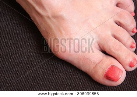 Varus Valgus And Hallux Valgus Or Bunion On Middle Aged Woman Foot. Isolated Closeup On White Backgr