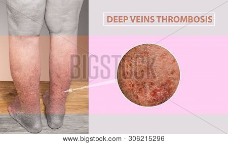 Deep Vein Thrombosis Or Blood Clots. Embolus. Structure Of Normal And Varicose Male Veins