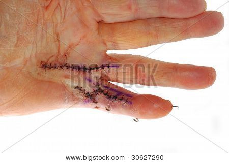 Hand kirurgi
