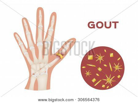 Gout In Human Hand Vector / Human, Anatomy
