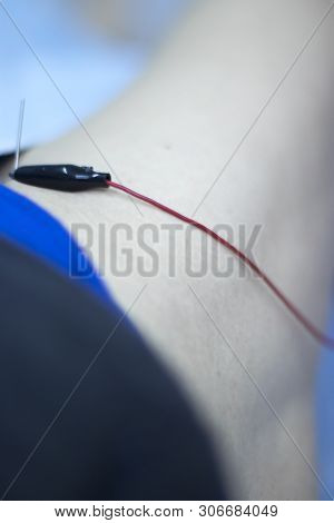 Epi Dry Needling Ultrasound Scan