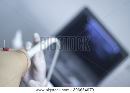 Epi Dry Needling Ultrasound Scan