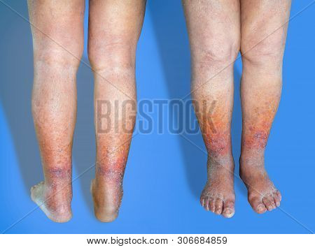 Close-up Of Skin With Varicose Veins On Senior Male Leg. Concept Of Dry Skin, Old Senior People, Var