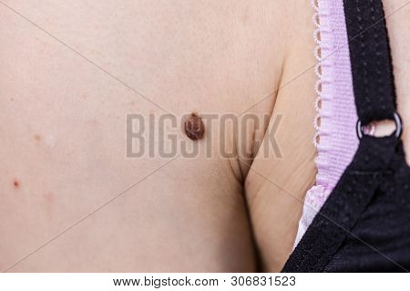 Unrecognizable Person Having Dark Fibroma, Dermatology Problem On Skin. Close Up Of Papilloma Dermat