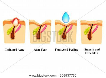 Inflamed Acne On The Skin. Inflamed Pimple. Acne Scar. Acid Peeling Treatment. The Structure Of The 