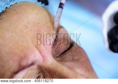 Closeup Woman Injection. Procedure Augmentation. Syringe Female Face, Hyaluronic Injection, Augmenta