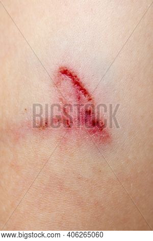 A Wound On The Human Body, Deep Cut, Scar Closeup. Deep Scratches On The Skin With Bruises.