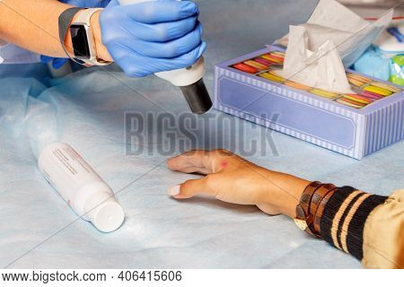 Laser Peeling Procedure In A Cosmetic Clinic. Beautician's Hand Holds A Laser Machine And Cleans The