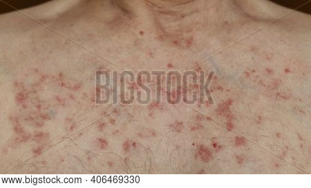 Skin Reaction On A Man Chest After Chemotherapy. Allergic Reaction. Allergic Rash On Chest Skin. Aft