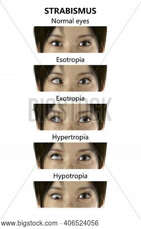 Strabismus In Children