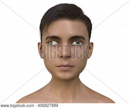 Strabismus In Children, Illustration
