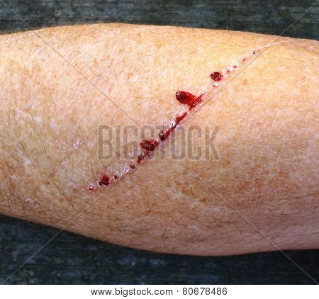 Injury