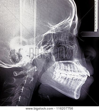 X-ray Scan Human For Teeth