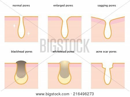 set of skin pores: normal, sagging, enlarged, blackhead, whitehead  and acne scar. beauty and skin care concept