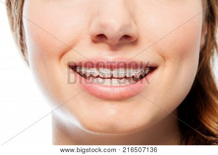 Close-up picture of happy woman's smile with orthodontic clear braces